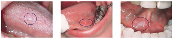 Oral Cancer Detection | Romie Lane Dental